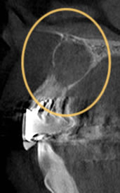 CT断面画像に写った空洞
