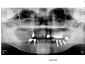 implant pre
