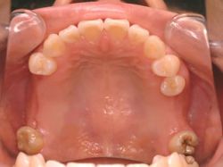 歯周病により左右の奥歯を失った患者さまの口腔内写真。歯周治療後の状態