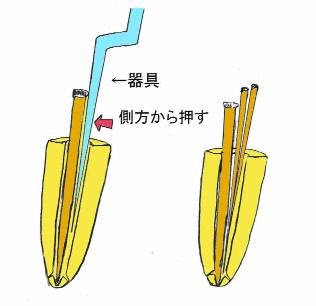 側方加圧根充法