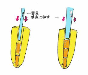 垂直加圧根充法