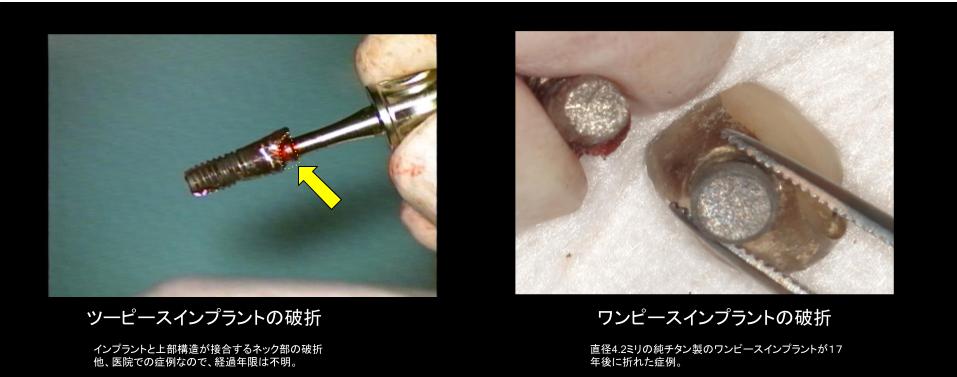 破折したインプラントの臨床写真2点。左＝ツーピースインプラントのネック部（インプラントと上部構造の接合部）の破折、右＝直径4.2ミリの純チタン製ワンピースインプラントが17年後に折れた症例