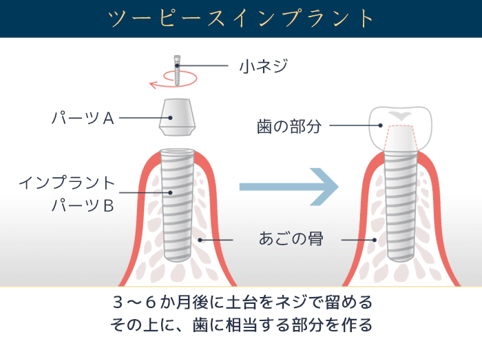 ツーピースインプラントの構造図。骨に埋めるパーツBと歯に相当するパーツAが分かれており、専用のネジで結合される仕組みを示した図