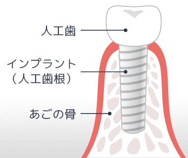 インプラントの構造を示す断面図。上から人工歯（被せ物）、あごの骨に埋め込まれたネジ状のインプラント（人工歯根）、それを支えるあごの骨という3つの部分で構成されている