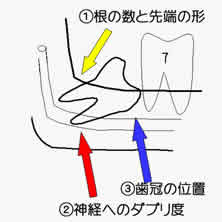 親知らずの根と下歯槽神経の位置関係を示す模式図。根が90度程度回転した親知らずでは麻痺のリスクが高くなる