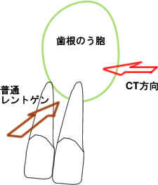 CTを見ている方向を示した説明図。CTはどの方向からでも断面を見ることができることを示している