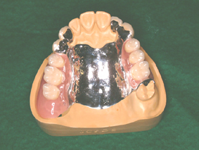 パーシャル・パラレル・ミリングによる義歯