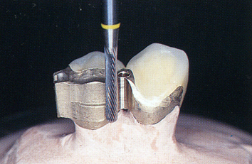 ミリング義歯は横揺れしにくい構造です