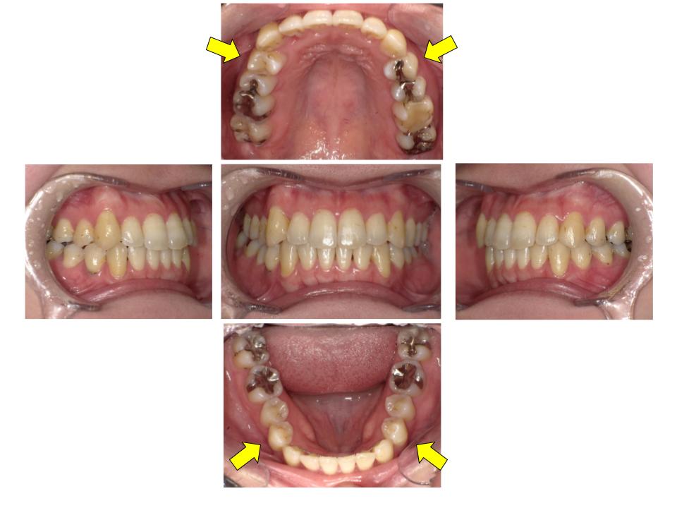 非抜歯症例３
