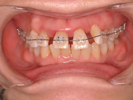 ２．歯周病治療と矯正治療