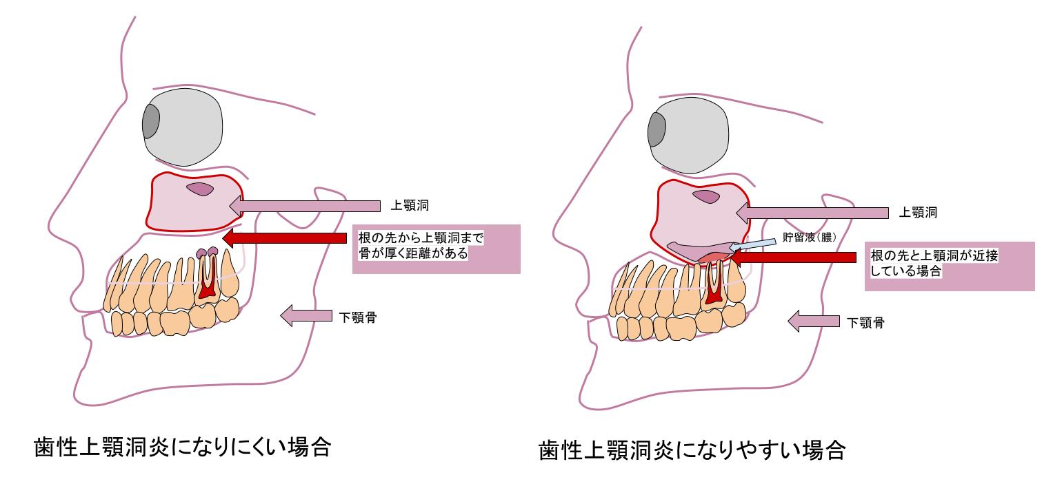 歯性上顎洞炎 - 抜歯をしないで治る - 小机歯科医院 - 横浜市港北区 - ケースルクト法根管治療 | 小机歯科医院|神奈川県横浜市港北区 ...
