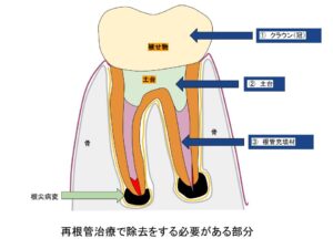 再根管治療