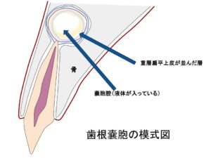 歯根嚢胞模式図