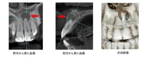 歯根嚢胞と思われる歯科用CT写真