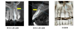 歯根嚢胞が切らずに治った症例