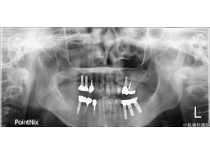 implant pre